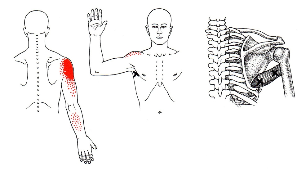 Teres Major | The Trigger Point & Referred Pain Guide